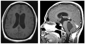 Image: MRI scan of a patient with neurocysticercosis (Photo courtesy of UCLA).